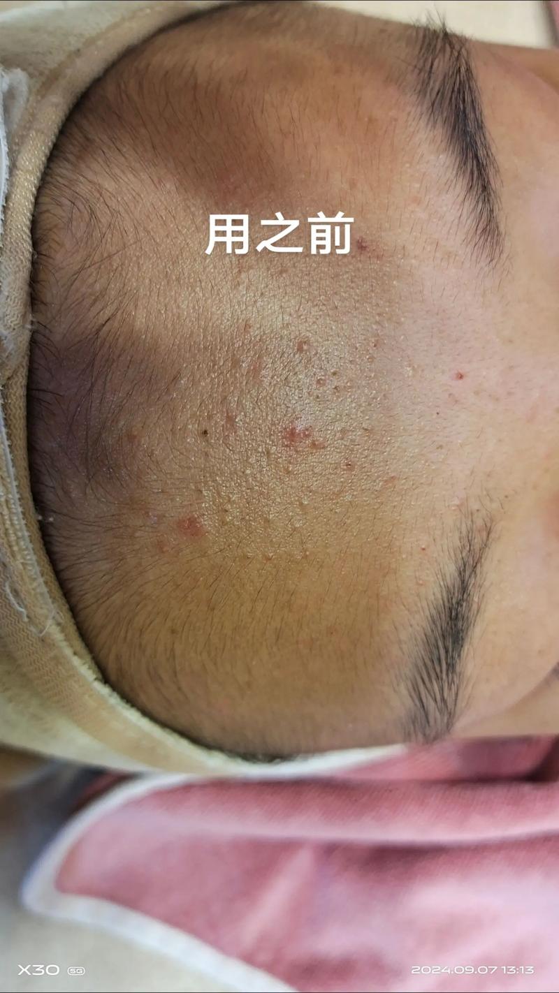 挤完痘痘能用洗面奶吗