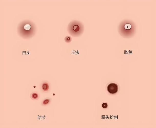 粉刺是什么引起的