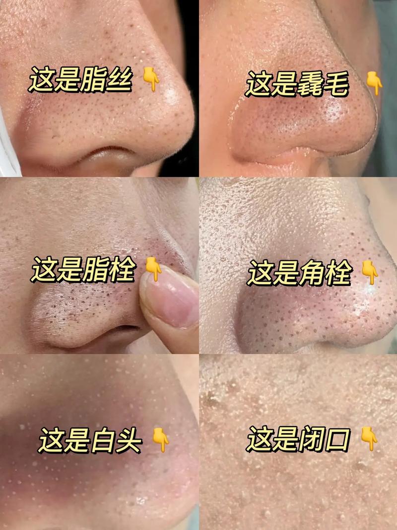 粉刺是什么引起的