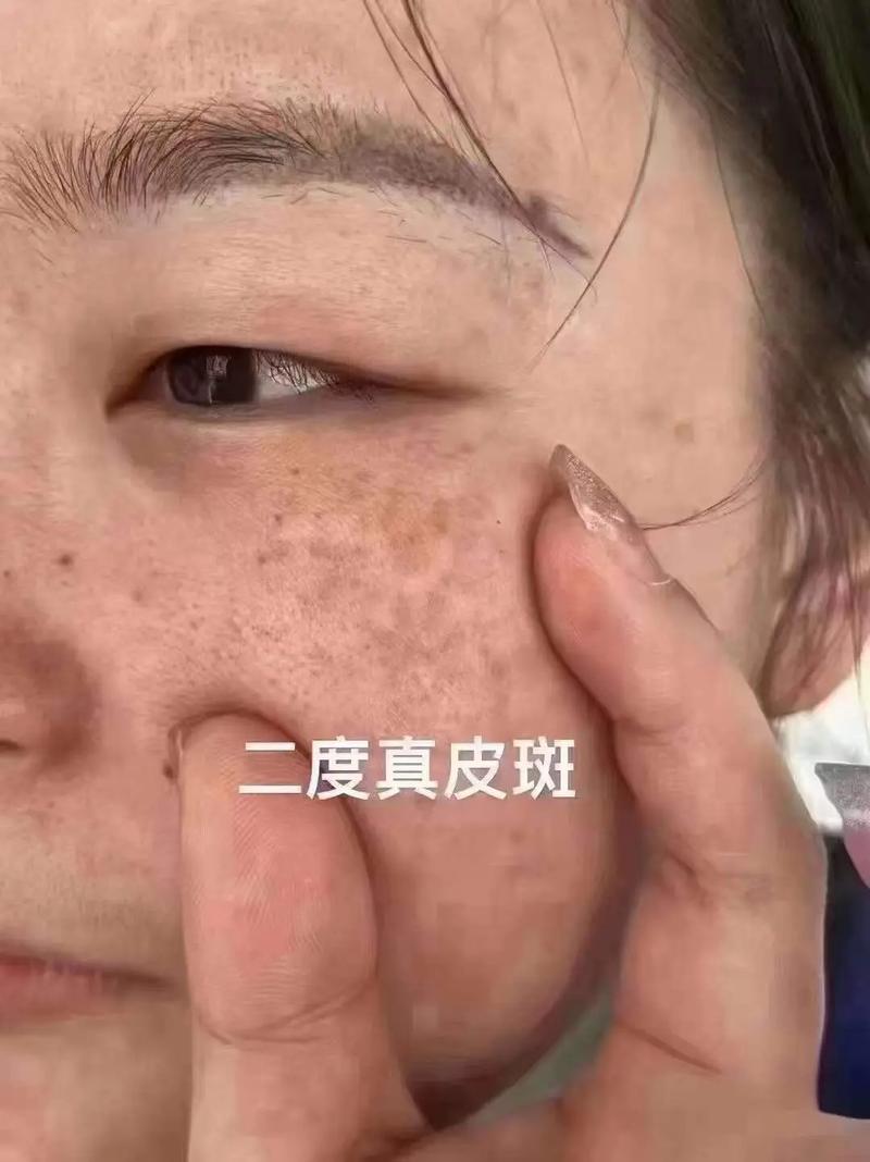 真皮斑是什么