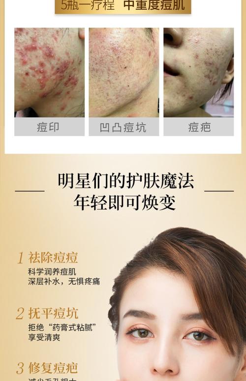 调理痘痘肌肤的护肤品