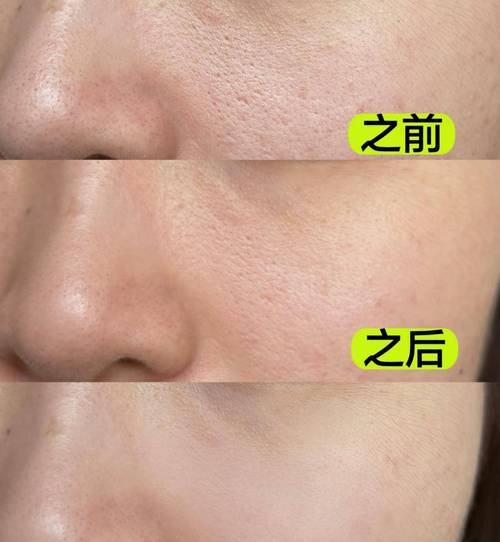 毛孔粗大能用洗面奶吗