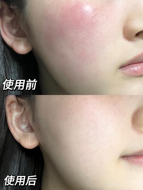 敏感肌发红修复护肤品