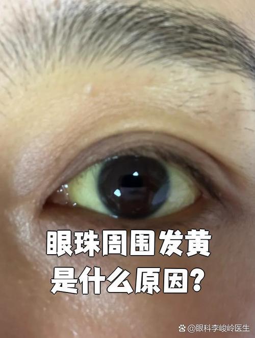 为什么眼睛会变黄