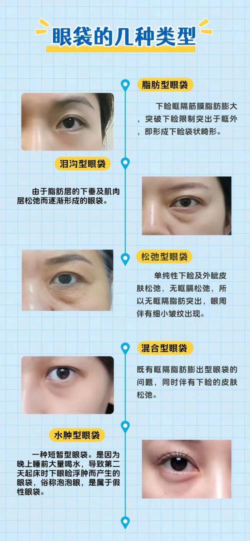 什么是眼袋图片