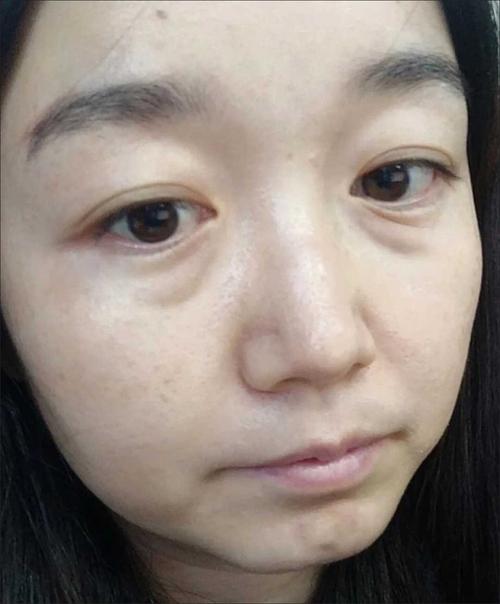 什么是眼袋图片