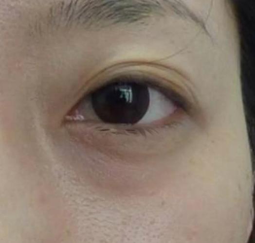 什么是眼袋图片