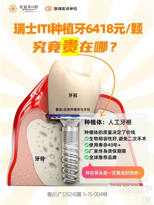 种植牙为什么贵