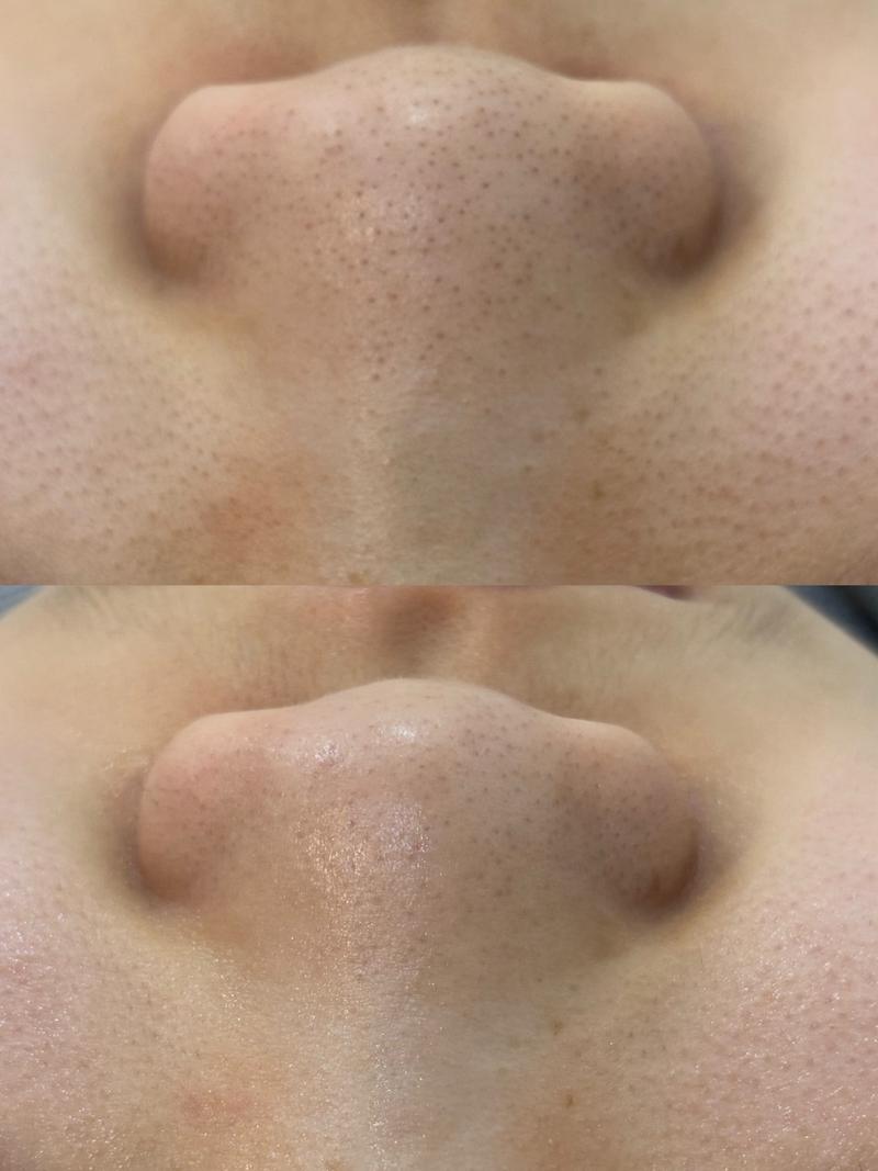 用洗面奶会使毛孔变大