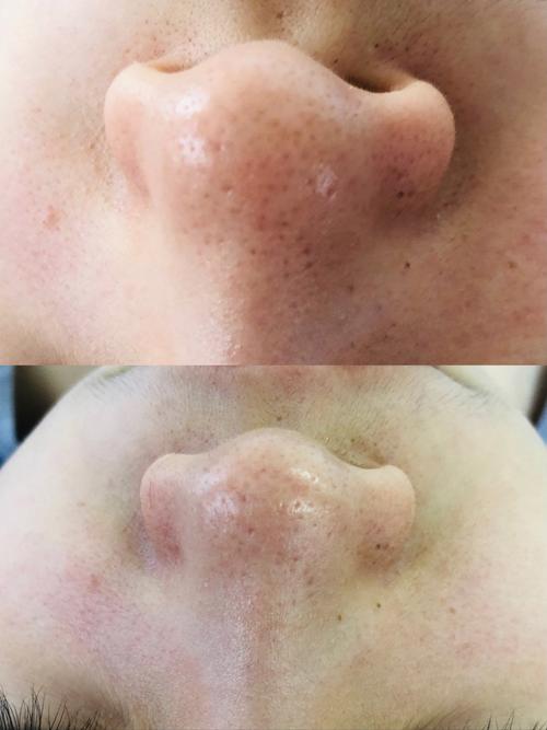 用洗面奶会使毛孔变大