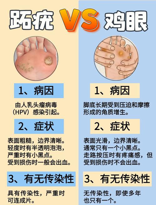 为什么脚长鸡眼