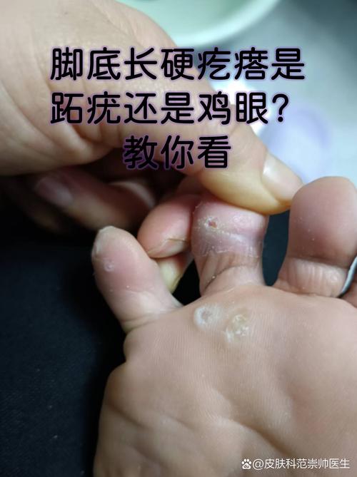 为什么脚长鸡眼