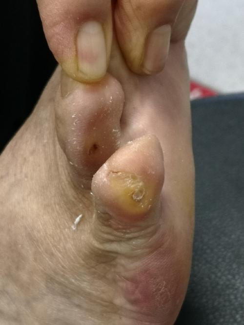 为什么脚长鸡眼