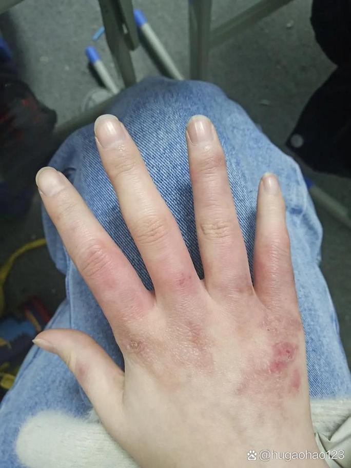 手为什么长冻疮