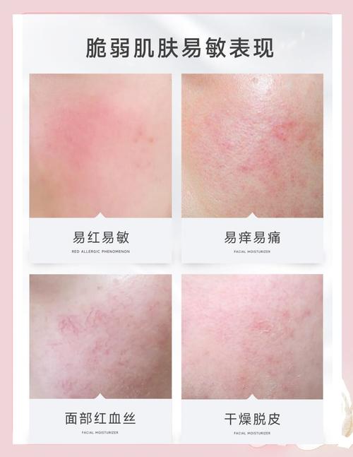 什么护肤品对敏感肌肤