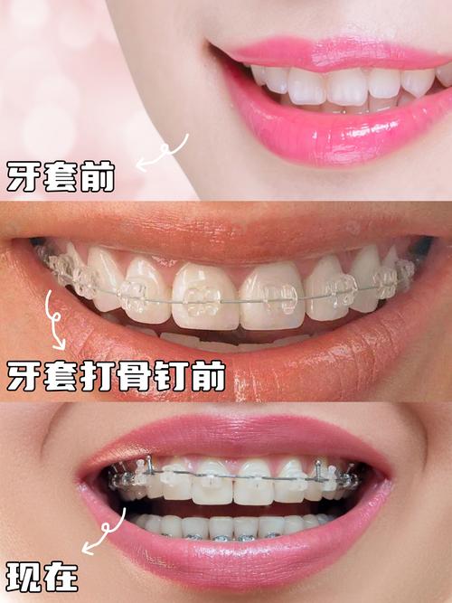 牙齿矫正是什么