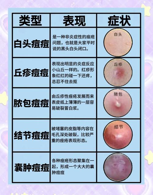 为什么会有痤疮