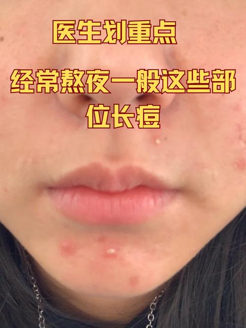 为什么满脸痘痘