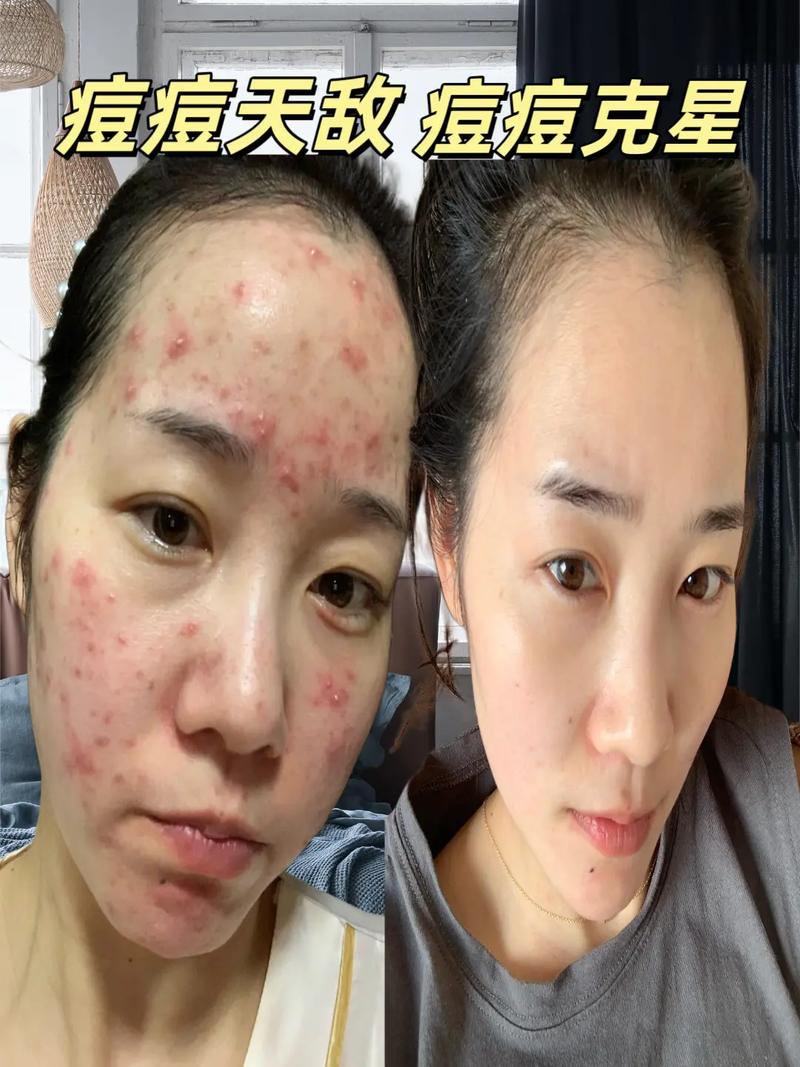 为什么满脸痘痘