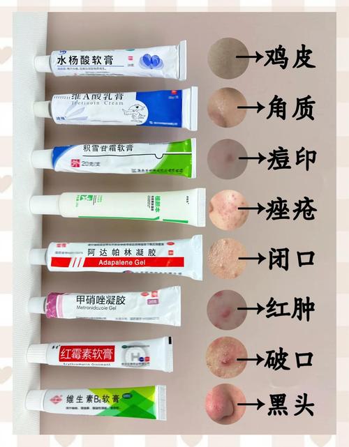 闭口粉刺什么护肤品好