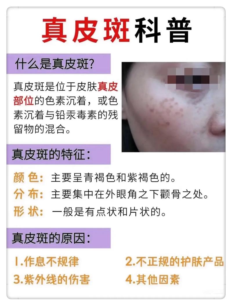 真皮斑是什么斑