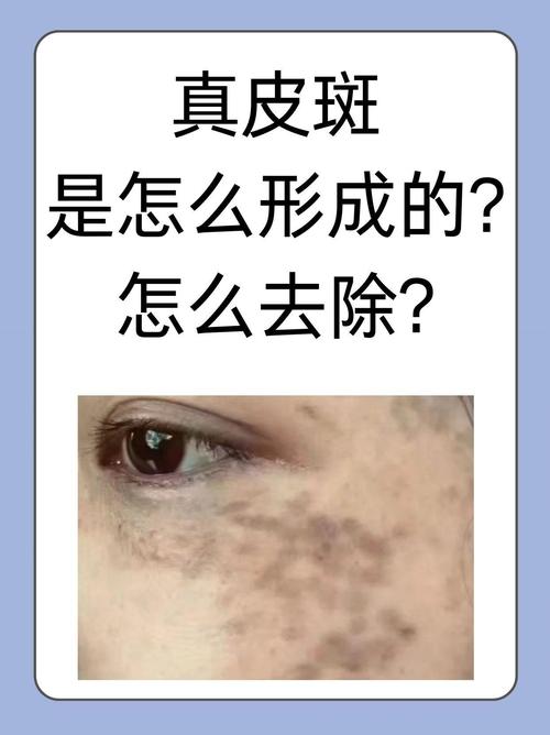 真皮斑是什么斑