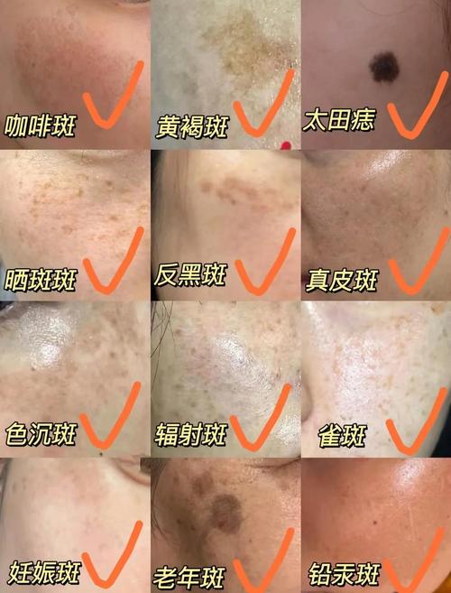 真皮斑是什么斑