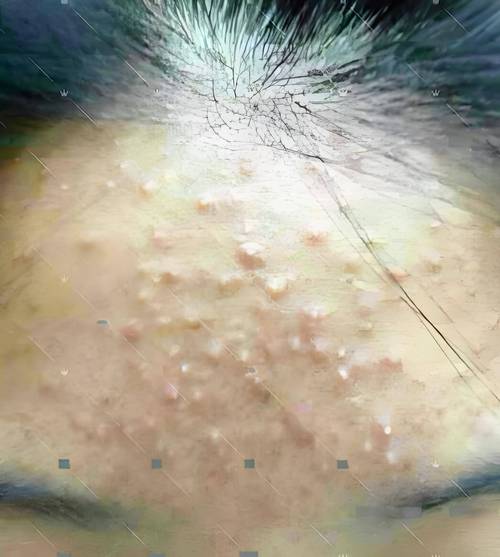 闭口粉刺什么样