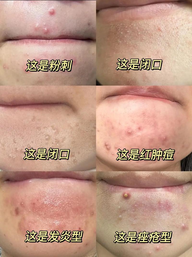 闭口粉刺什么样