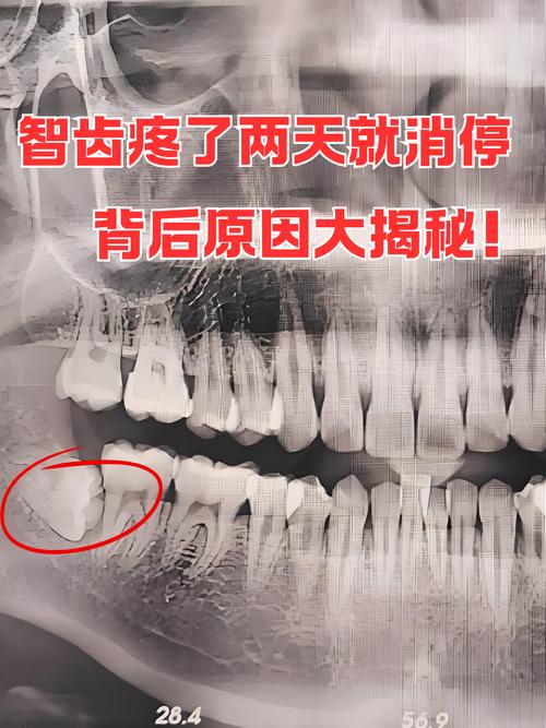 为什么长智齿会疼