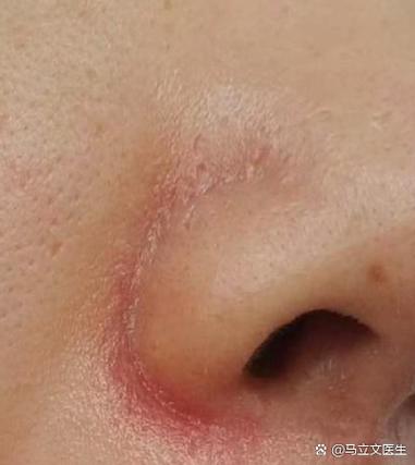 鼻头发红什么原因
