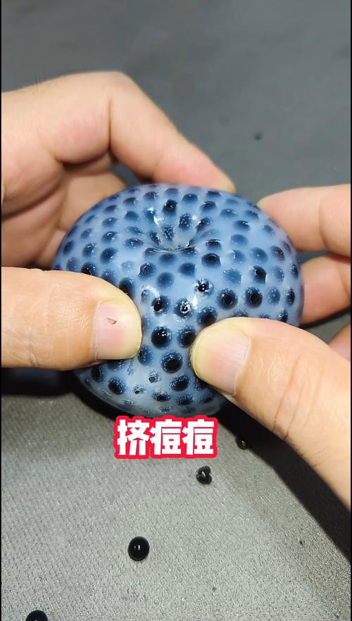 痘痘挤出来的是什么