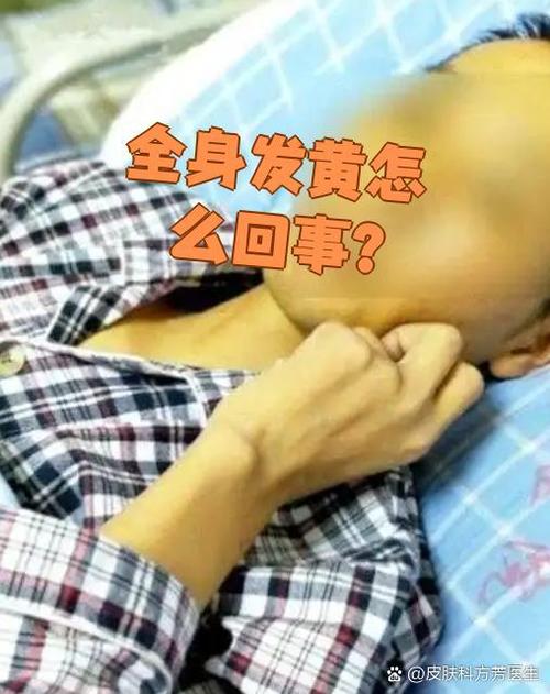 全身发黄是什么病