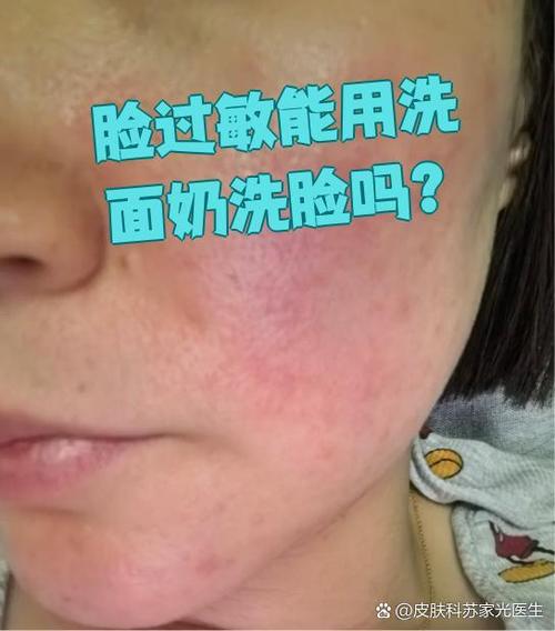 洗面奶过敏多久有反应