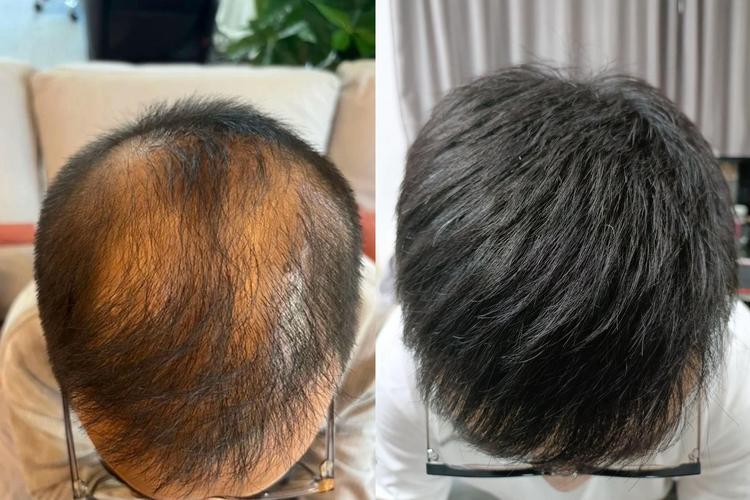 脱发有什么症状