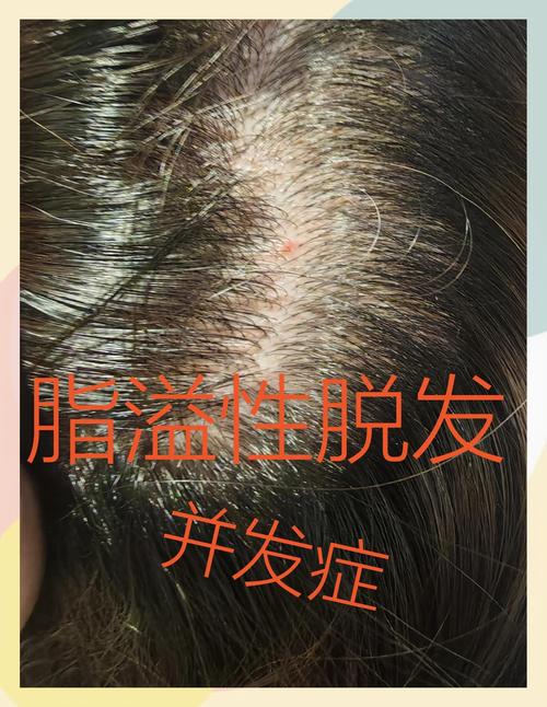 脱发有什么症状