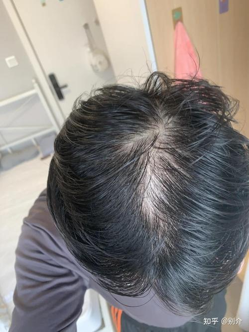 脱发有什么症状