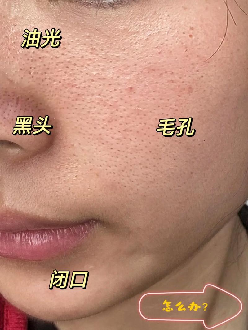 使用洗面奶后毛孔变大