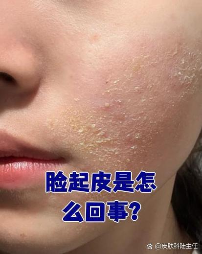 为什么脸会掉皮