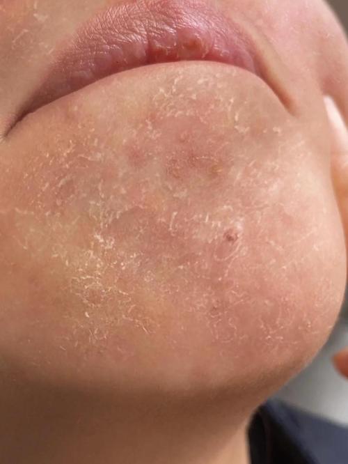 为什么脸会掉皮