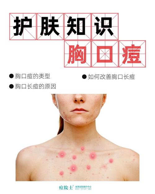 为什么胸前长痘痘