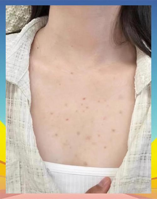 为什么胸前长痘痘