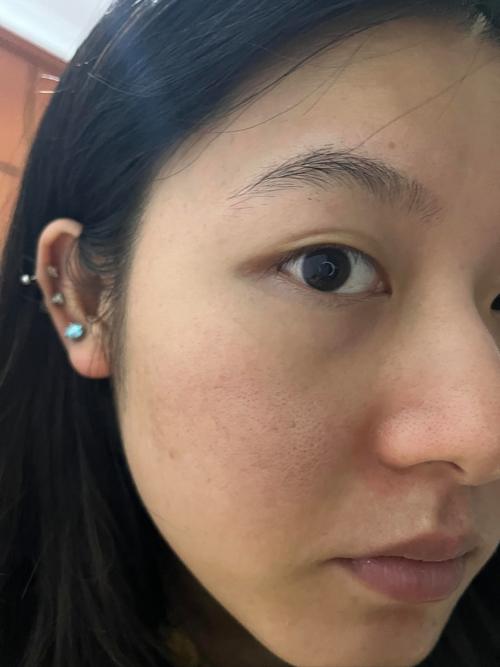 用补水护肤品皮肤变黑