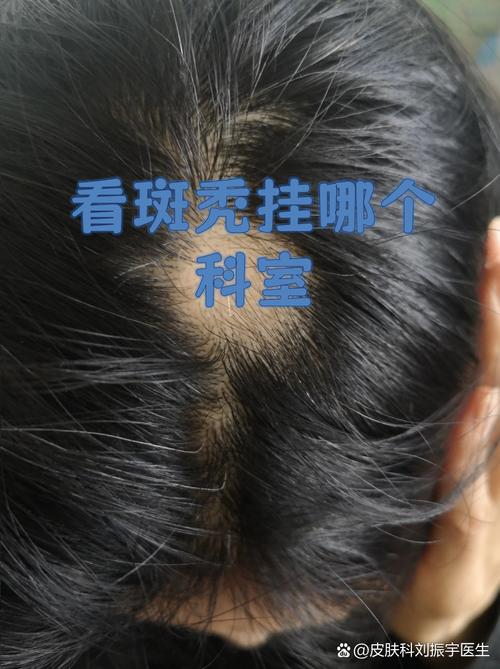 脱发挂中医什么科
