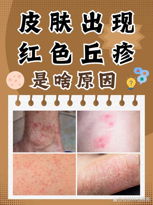 丘疹是什么意思