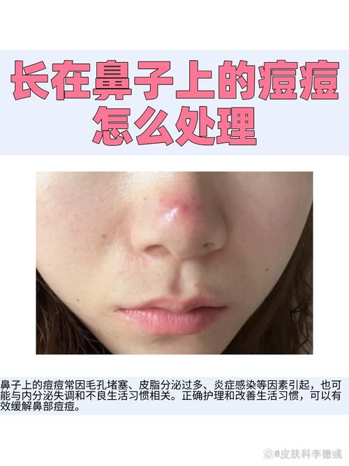 鼻头长痘什么原因