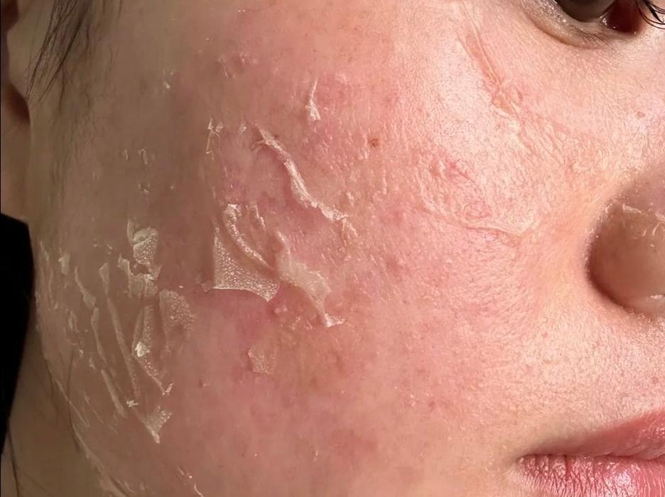 用玉兰油护肤品脸起皮