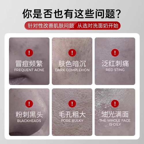 军献祛痘洗面奶怎么样