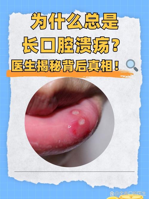 口疮是什么引起的