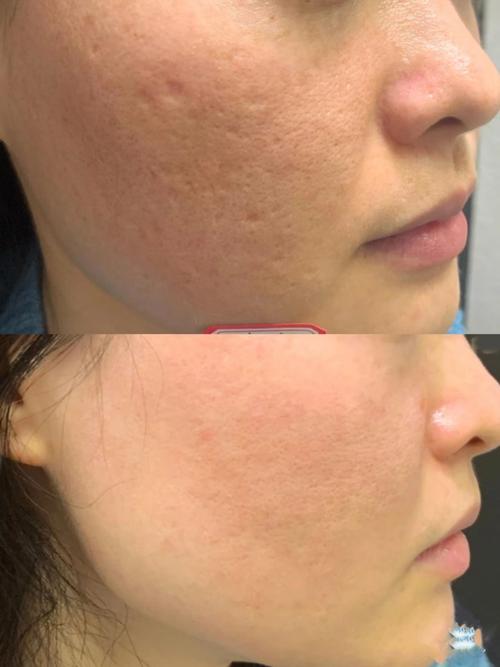 微针后可以涂护肤品吗